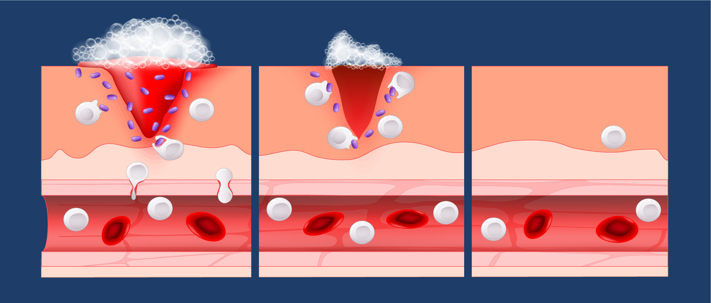 Using foam to deliver nitric oxide